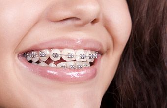 Tips During Orthodontics Invisalign