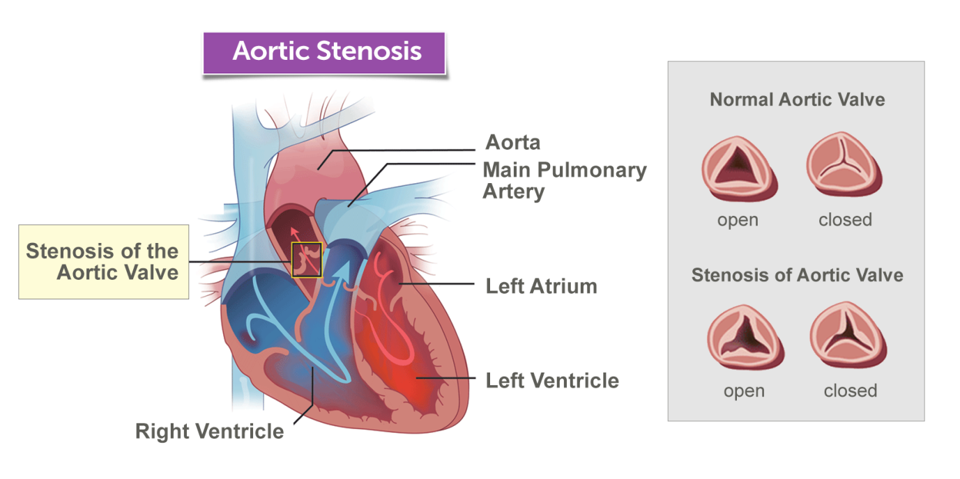 Aortic Stenosis: Diagnosis And Available Treatments