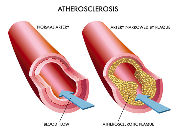 Atherosclerosis Disease