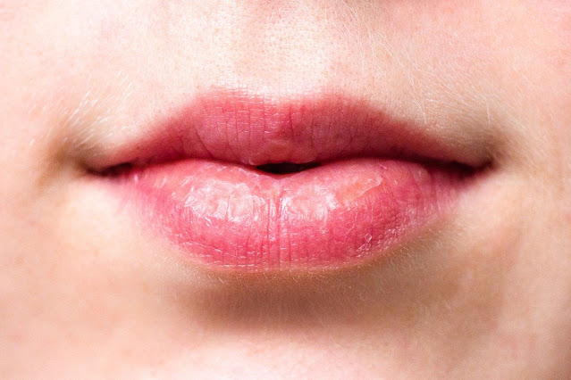 9 Reasons Why Your Mouth Corners Crack