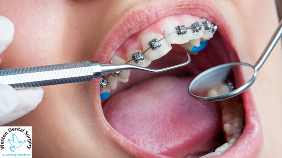 What Are Braces And Things To Know Before Getting Them?