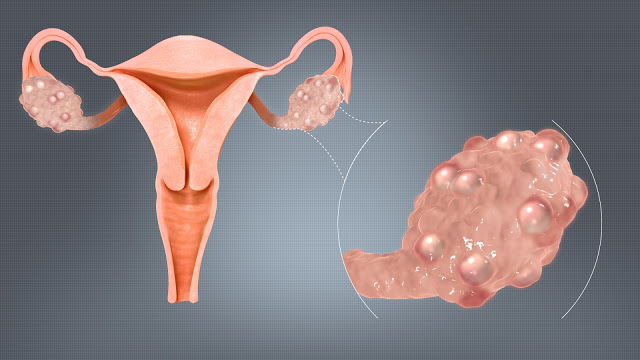 4 Essential Things About Ruptured Ovarian Cyst Every Woman Should Know