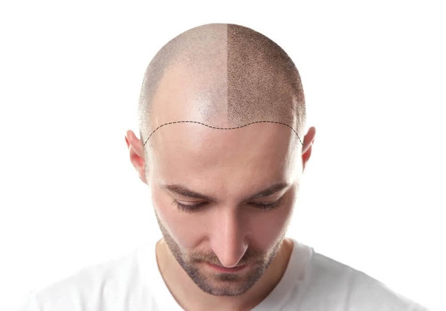 Who Is The Best Hair Transplant Surgeon In Jaipur