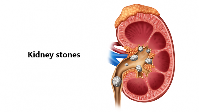 Signs Of Kidney Stones